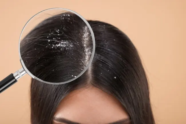 rambut ketombe