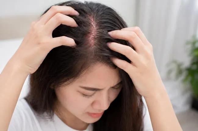 kulit kepala sensitif