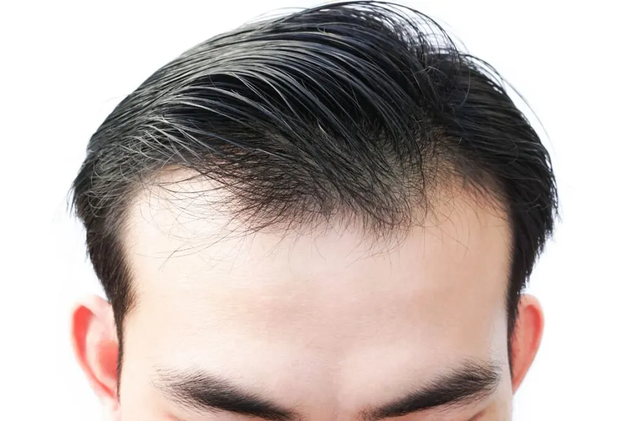 Garis Rambut Mundur