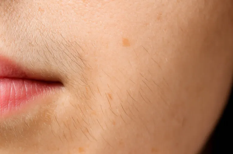 10 Penyebab Hirsutisme dan 6 Tips Efektif Mengelolanya