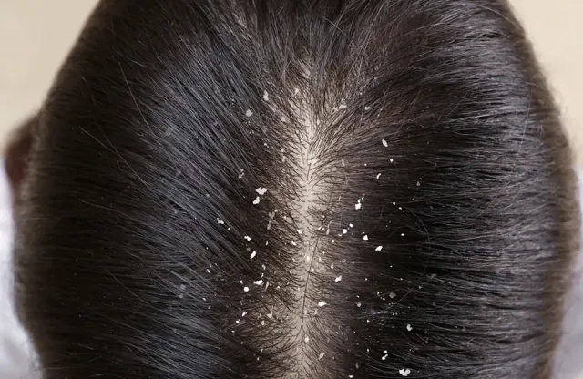 5 Masalah Rambut Ketombe yang Sering Muncul di Musim Kemarau